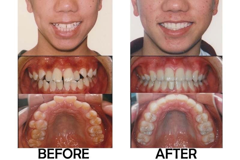 Teen Orthodontics - Bellflower Dentist Orthodontics and Sleep Apnea