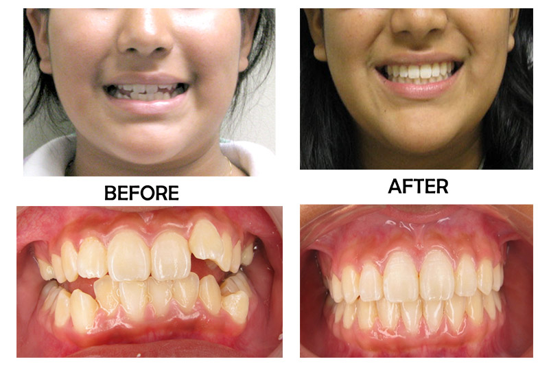 Teen Orthodontics - Bellflower Dentist Orthodontics and Sleep Apnea