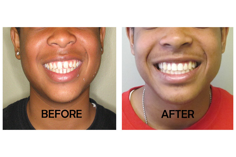 Teen Orthodontics - Bellflower Dentist Orthodontics and Sleep Apnea